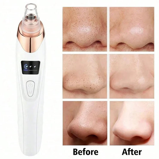 ClearSculpt Pro – Electric Blackhead Remover